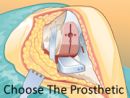 Choose The Prosthetic